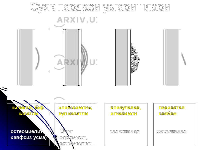 Суяк пардаси узгаришлари чизикли, бир каватли «пиёзсимон», куп каватли спикулалар, игнасимон периостал соябон остеомиелит, хавфсиз усма) Юинг саркомаси, остеомиелит саркомалар саркомалар 