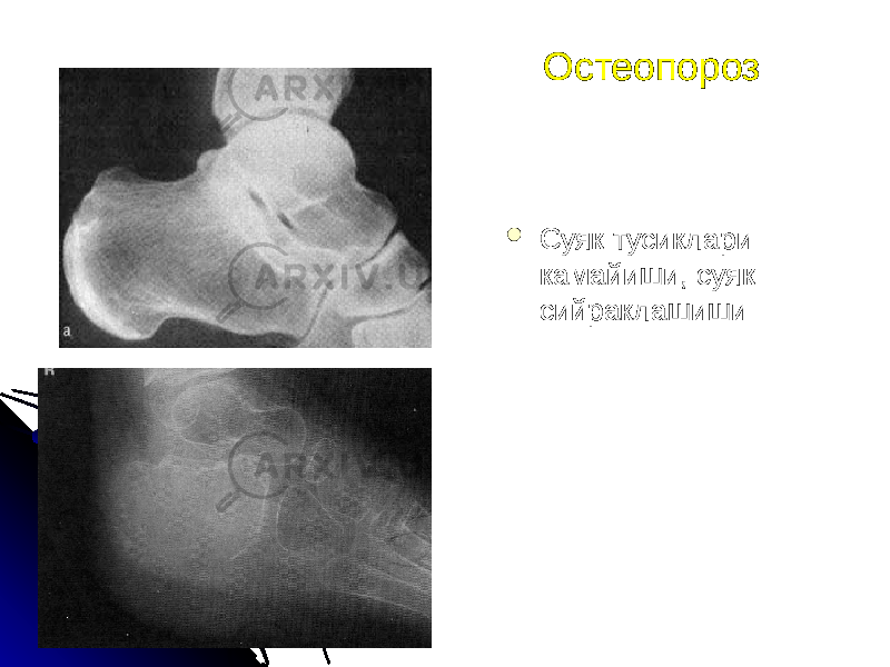 Остеопороз  Суяк тусиклари камайиши, суяк сийраклашиши 