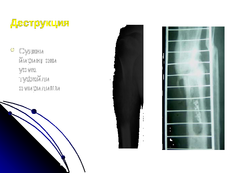 Деструкция  Суякни йиринг еки усма туфайли емирилиши 