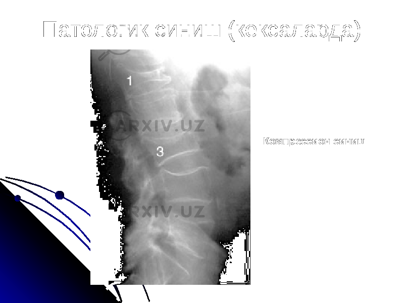 Патологик синиш (кексаларда) Компрессион синиш 