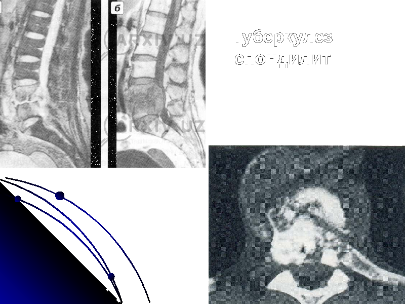 Туберкулез спондилит 