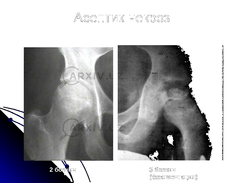 Асептик некроз 2 боскич 3 боскич (фрагментация) 