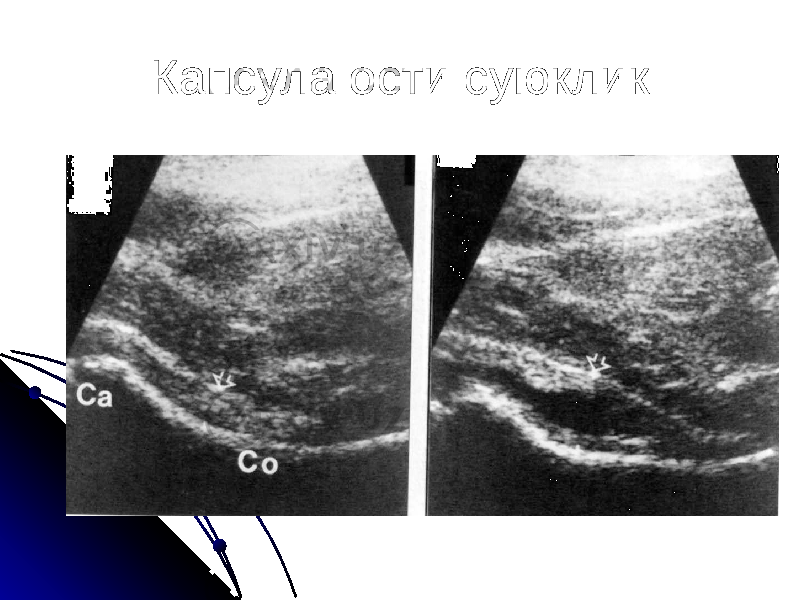 Капсула ости суюклик 