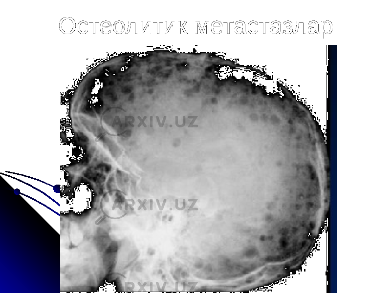 Остеолитик метастазлар 