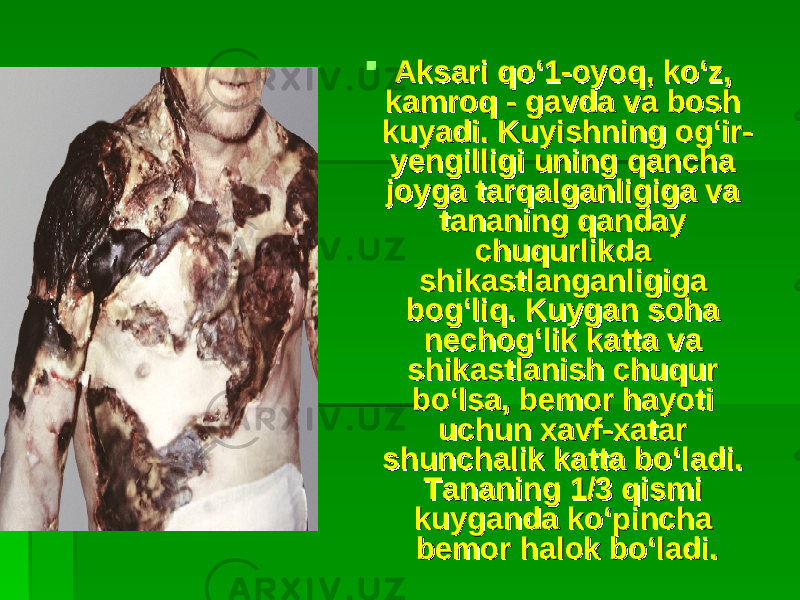  Aksari qo‘1-oyoq, ko‘z, Aksari qo‘1-oyoq, ko‘z, kamroq - gavda va bosh kamroq - gavda va bosh kuyadi. Kuyishning og‘ir-kuyadi. Kuyishning og‘ir- yengilligi uning qancha yengilligi uning qancha joyga tarqalganligiga va joyga tarqalganligiga va tananing qanday tananing qanday chuqurlikda chuqurlikda shikastlanganligiga shikastlanganligiga bog‘liq. Kuygan soha bog‘liq. Kuygan soha nechog‘lik katta va nechog‘lik katta va shikastlanish chuqur shikastlanish chuqur bo‘lsa, bemor hayoti bo‘lsa, bemor hayoti uchun xavf-xatar uchun xavf-xatar shunchalik katta bo‘ladi. shunchalik katta bo‘ladi. Tananing 1/3 qismi Tananing 1/3 qismi kuyganda ko‘pincha kuyganda ko‘pincha bemor halok bo‘ladi. bemor halok bo‘ladi. 