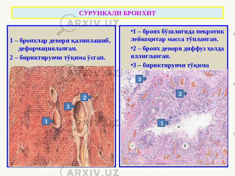 1 – бронхлар девори қалинлашиб, деформацияланган. 2 – бириктирувчи тўқима ўсган. • 1 – бронх бўшлиғида некротик лейкоцитар масса тўпланган. • 2 – бронх девори диффуз ҳолда яллиғланган. • 3 – бириктирувчи тўқима ўсган.СУРУНКАЛИ БРОНХИТ 1 1 2 1 23 