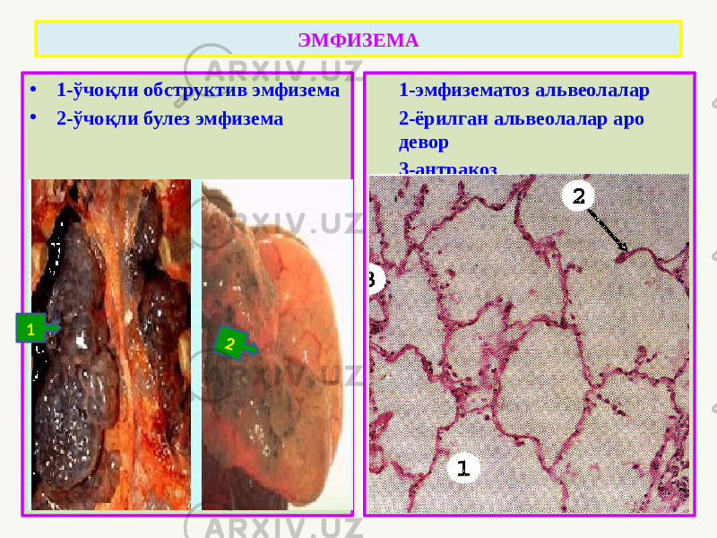 • 1-ўчоқли обструктив эмфизема • 2-ўчоқли булез эмфизема 1-эмфизематоз альвеолалар 2-ёрилган альвеолалар аро девор 3-антракозЭМФИЗЕМА 12 