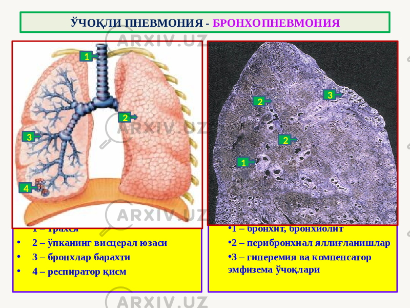 • 1 – трахея • 2 – ўпканинг висцерал юзаси • 3 – бронхлар барахти • 4 – респиратор қисм • 1 – бронхит, бронхиолит • 2 – перибронхиал яллиғланишлар • 3 – гиперемия ва компенсатор эмфизема ўчоқлариЎЧОҚЛИ ПНЕВМОНИЯ - БРОНХОПНЕВМОНИЯ 1 2 2 31 2 3 4 