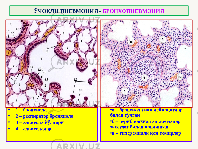 • 1 – бронхиола • 2 – респиратор бронхиола • 3 – альвеола йўллари • 4 – альвеолалар • а – бронхиола ичи лейкоцитлар билан тўлган • б – перибронхиал альвеолалар экссудат билан қопланган • в – гиперемияли қон томирларЎЧОҚЛИ ПНЕВМОНИЯ - БРОНХОПНЕВМОНИЯ 1 2 2 31 2 3 4 