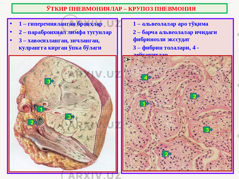 • 1 – гиперемияланган бронхлар • 2 – парабронхиал лимфа тугунлар • 3 – хавосизланган, зичланган, кулрангга кирган ўпка бўлаги 1 – альвеолалар аро тўқима 2 – барча альвеолалар ичидаги фибринозли экссудат 3 – фибрин толалари, 4 - лейкоцитлар ЎТКИР ПНЕВМОНИЯЛАР – КРУПОЗ ПНЕВМОНИЯ 1 2 3 3 1 2 2 34 
