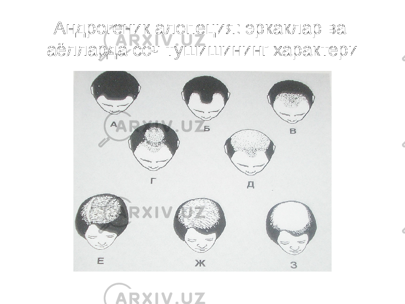 Андрогеник алопеция: эркаклар ва аёлларда соч тушишининг характери 