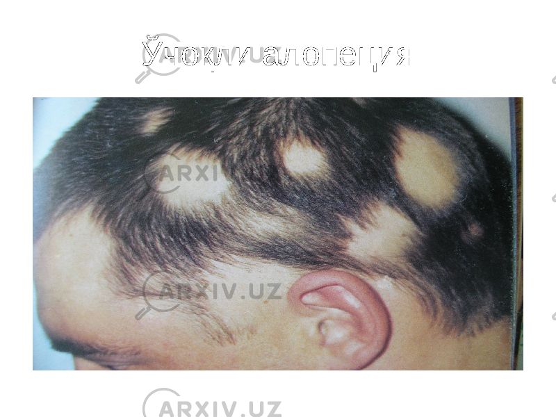 Ўчоқли алопеция 