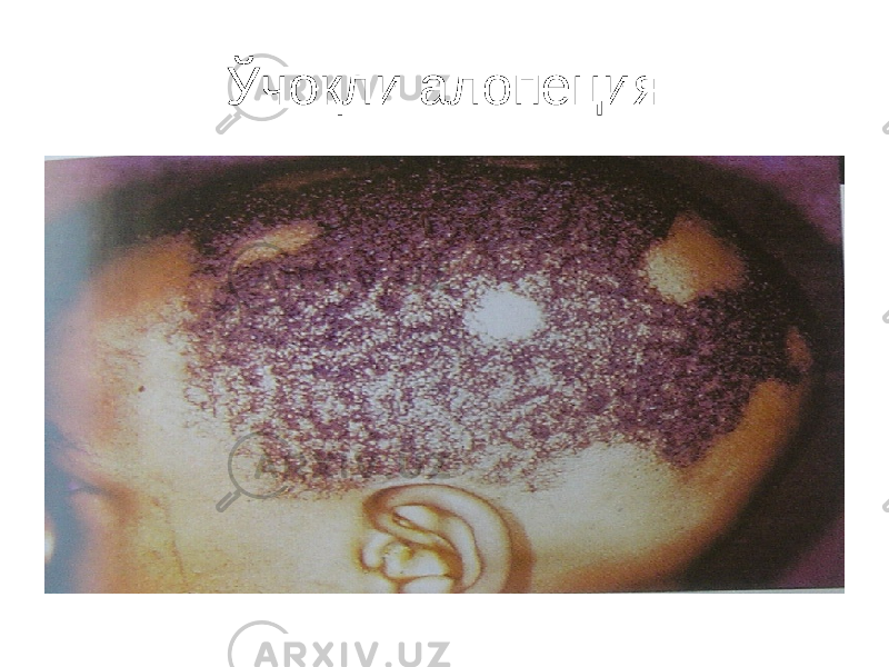 Ўчоқли алопеция 