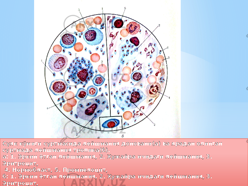 Суяк кўмиги суртмасида лейшмания доновани(а) ва ярадан олинган суртмада лейшмания тропика(б). а: 1. Эркин ётган лейшмания, 2. Ҳужайра ичидаги лейшмания, 3. Эритроцит, 4. Нормобласт, 5. Промиелоцит, б: 1. Эркин ётган лейшмания, 2. Ҳужайра ичидаги лейшмания, 3. Эритроцит, 4. Нейтрофил, 5. Лимфоцит4A 18 0535 10 03 4F 1F 10 03 4F 