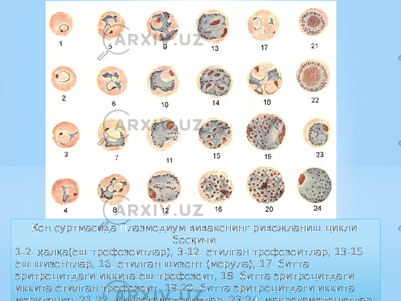 Қон суртмасида Плазмодиум вивакснинг ривожланиш цикли босқичи: 1-2. ҳалқа(ёш трофозоитлар); 3-12. етилган трофозоитлар; 13-15. ёш шизонтлар; 16. етилган шизонт (морула); 17. битта эритроцитдаги иккита ёш трофозоит; 18. битта эритроцитдаги иккита етилган трофозоит; 19-20. битта эритроцитдаги иккита меруляция; 21-22. микрогаметоцитлар; 23-24. макрогаметоцитлар.74 16 30 22 27 0517 14 