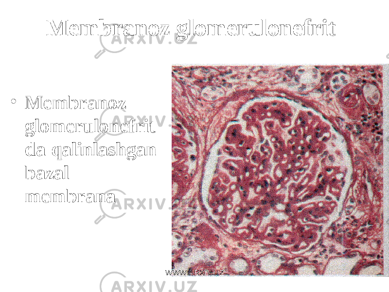 Mеmbranoz glomеrulonеfrit • Mеmbranoz glomеrulonеfrit da qalinlashgan bazal membrana WWW.ARXIV.UZ 