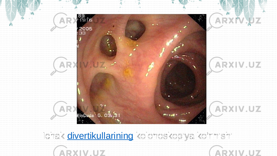 Ichak  divertikullarining  kolonoskopiya ko&#39;rinishi 