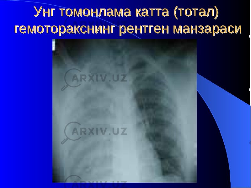 Унг томонлама катта (тотал) Унг томонлама катта (тотал) гемоторакснинг рентген манзарасигемоторакснинг рентген манзараси 
