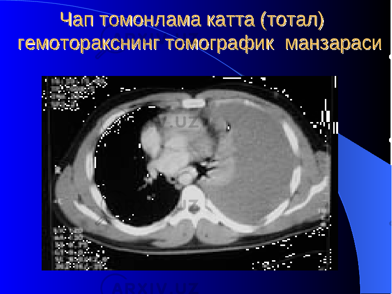 Чап томонлама катта (тотал) Чап томонлама катта (тотал) гемоторакснинг томографик манзарасигемоторакснинг томографик манзараси 