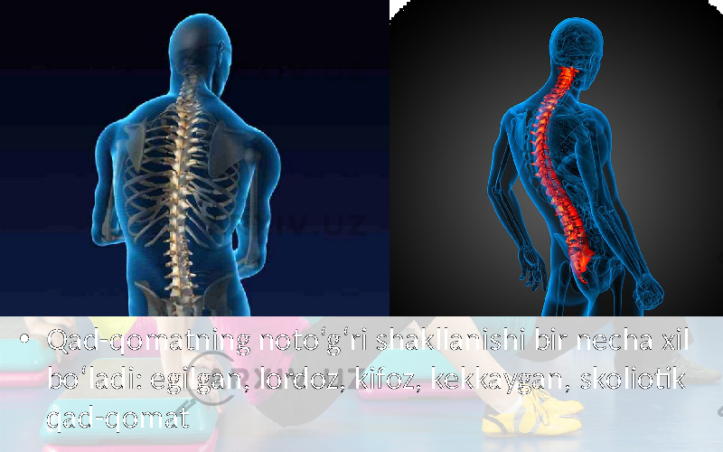 • Qad-qomatning noto‘g‘ri shakllanishi bir necha xil bo‘ladi: egilgan, lordoz, kifoz, kekkaygan, skoliotik qad-qomat 