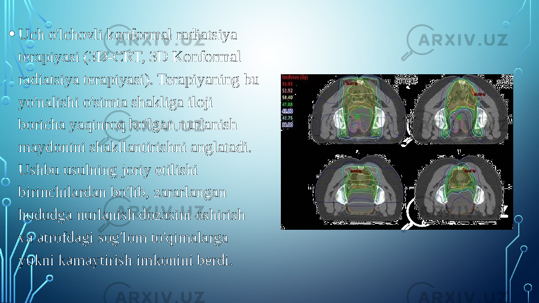 • Uch o&#39;lchovli konformal radiatsiya terapiyasi (3D-CRT, 3D Konformal radiatsiya terapiyasi). Terapiyaning bu yo&#39;nalishi o&#39;simta shakliga iloji boricha yaqinroq bo&#39;lgan nurlanish maydonini shakllantirishni anglatadi. Ushbu usulning joriy etilishi birinchilardan bo&#39;lib, zararlangan hududga nurlanish dozasini oshirish va atrofdagi sog&#39;lom to&#39;qimalarga yukni kamaytirish imkonini berdi. 