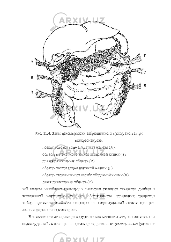Рис. 11.4. Зоны декомпрессии забрюшинного пространства при панкреонекрозе: позади головки поджелудочной железы (А); область печеночного изгиба ободочной кишки (Б); правая паракольная область (В); область хвоста поджелудочной железы (Г); область селезеночного изгиба ободочной кишки (Д): левая паракольная область (Е). ной железы неизбежно приводит к развитию тяжелого сахарного диабета и экзокринной недостаточности. Эти обстоятельства определяют трудности выбора адекватного объема операции на поджелудочной железе при раз - личных формах панкреонекроза. В зависимости от характера хирургических вмешательств, выполняе мых на поджелудочной железе при панкреонекрозе, различают резекцион ные (удаление 