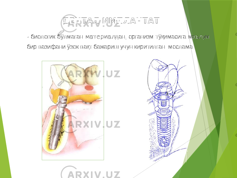 ДЕНТАЛ ИМПЛАНТАТ - биологик бўлмаган материал дан, организм тўқимасига маълум бир вазифани ўзок вақт бажариш учун киритилган мослама 