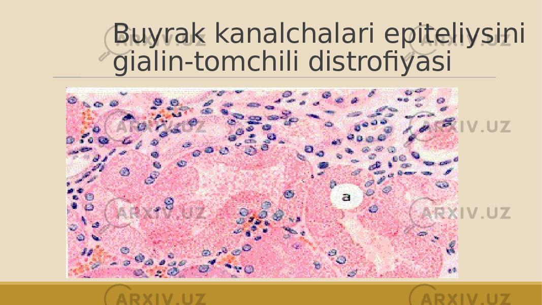 Buyrak kanalchalari epiteliysini gialin-tomchili distrofiyasi 