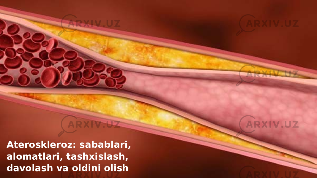 Ateroskleroz: sabablari, alomatlari, tashxislash, davolash va oldini olish 