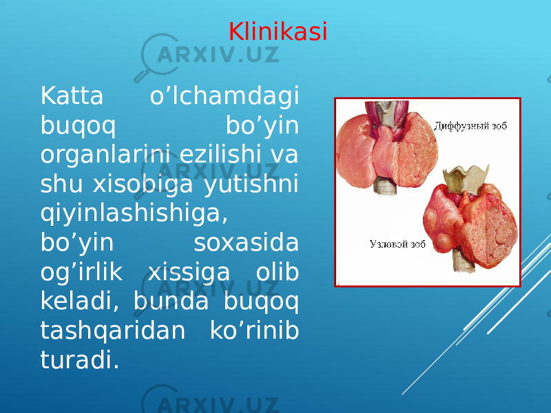 Katta o’lchamdagi buqoq bo’yin organlarini ezilishi va shu xisobiga yutishni qiyinlashishiga, bo’yin soxasida og’irlik xissiga olib keladi, bunda buqoq tashqaridan ko’rinib turadi. Klinikasi 