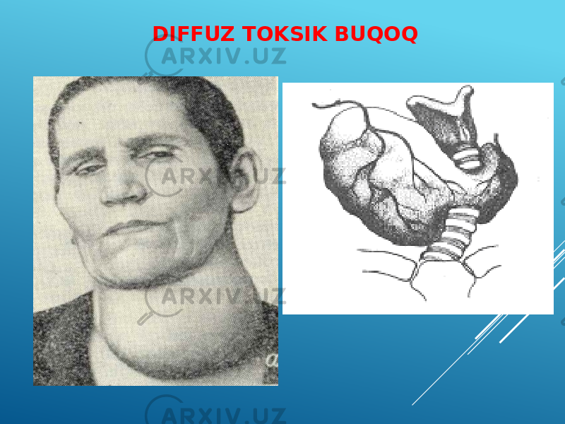 DIFFUZ TOKSIK BUQOQ 