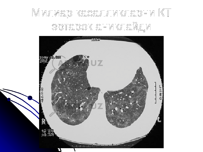 Милиар касалликларни КТ эртарок аниклайди 