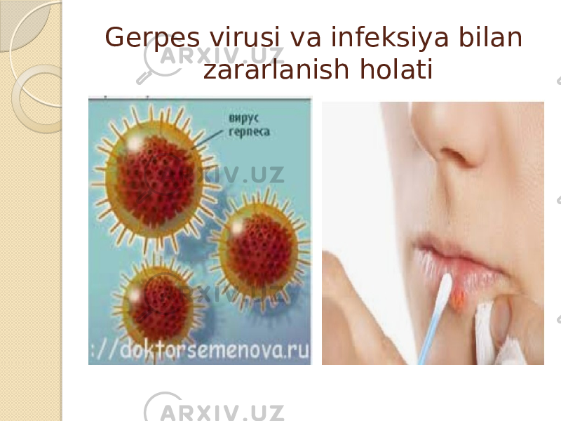 Gerpes virusi va infeksiya bilan zararlanish holati 