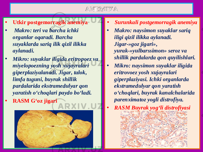 • Utkir postgemorragik anemiya • Makro: teri va barcha ichki organlar oqaradi. Barcha suyaklarda sariq ilik qizil ilikka aylanadi. • Mikro: suyaklar iligida eritropoez va miyelopoezning yosh xujayralari giperplaziyalanadi. Jigar, talok, limfa tuguni, buyrak shillik pardalarida ekstramedulyar qon yaratish o‘choqlari paydo bo‘ladi. • RASM G‘oz jigari • Surunkali postgemorragik anemiya • Makro: naysimon suyaklar sariq iligi qizil ilikka aylanadi. Jigar-»goz jigari», yurak-»yulbarssimon» seroz va shillik pardalarda qon quyilishlari. • Mikro: naysimon suyaklar iligida eritrovoez yosh xujayralari giperplaziyasi. Ichki organlarda ekstramedulyar qon yaratish o‘choqlari, buyrak kanalchalarida parenximatoz yogli distrofiya. • RASM Buyrak yog‘li distrofiyasiANEMIYA 