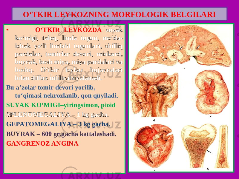 • O‘TKIR LEYKOZDA suyak ko‘migi, taloq, limfa tugun, me’da- ichak yo‘li limfoid tugunlari, shilliq pardalar, tomirlar devori, miokard, buyrak, bosh miya, miya pardalari va boshq. O‘tkir leykoz hujayralari bilan diffuz infiltratsiyalanadi. Bu a’zolar tomir devori yorilib, to‘qimasi nekrozlanib, qon quyiladi. SUYAK KO‘MIGI–yiringsimon, pioid SPLENOMEGALIYA – 1 kg gacha. GEPATOMEGALIYA – 3 kg gacha. BUYRAK – 600 gr.gacha kattalashadi. GANGRENOZ ANGINA O‘TKIR LEYKOZNING MORFOLOGIK BELGILARI 