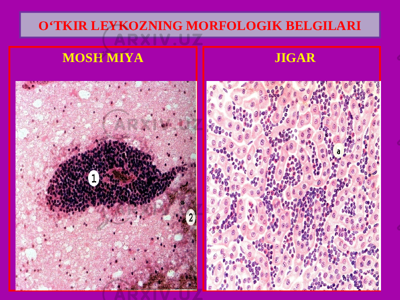 MOSH MIYA JIGARO‘TKIR LEYKOZNING MORFOLOGIK BELGILARI 