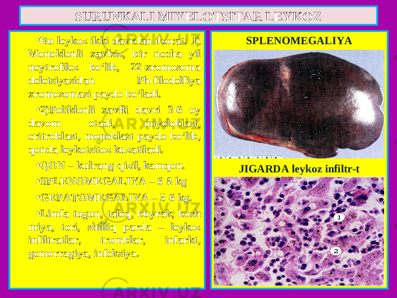 • Bu leykoz ikki davrdan iborat: 1) Monoklonli xavfsiz, bir necha yil neytrofilez bo‘lib, 22-xromosoma deletsiyasidan Ph-filodelfiya xromosomasi paydo bo‘ladi. • 2)Poliklonli xavfli davri 3-6 oy davom etadi, miyeloblast, eritroblast, monoblast paydo bo‘lib, qonda leykotsitoz kuzatiladi. • QON – kulrang-qizil, kamqon. • SPLENOMEGALIYA – 6-8 kg • GEPATOMEGALIYA – 5-6 kg. • Limfa tugun, taloq, buyrak, bosh miya, teri, shilliq parda – leykoz infiltratlar, tromblar, infarkt, gemorragiya, infeksiya. SPLENOMEGALIYA JIGARDA leykoz infiltr-tSURUNKALI MIYELOTSITAR LEYKOZ 