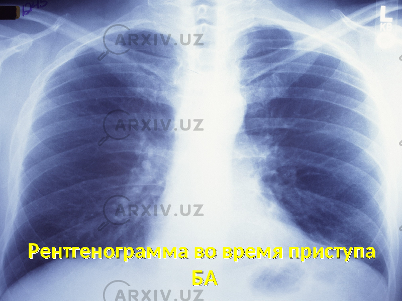 Рентгенограмма во время приступа Рентгенограмма во время приступа БАБА 