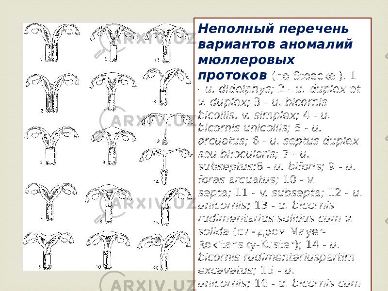  Неполный перечень вариантов аномалий мюллеровых протоков (по Stoeckel): 1 -  u. didelphys;  2 -  u. duplex et v. duplex;  3 -  u. bicornis bicollis, v. simplex;  4 -  u. bicornis unicollis;  5 -  u. arcuatus;  6 -  u. septus duplex seu bilocularis;  7 -  u. subseptus; 8 -  u. biforis;  9 -  u. foras arcuatus;  10 -  v. septa;  11 -  v. subsepta;  12 -  u. unicornis;  13 -  u. bicornis rudimentarius solidus cum v. solida  (синдром Mayer- Rokitansky-Kuster); 14 -  u. bicornis rudimentariuspartim excavatus;  15 -  u. unicornis;  16 -  u. bicornis cum haematometra 