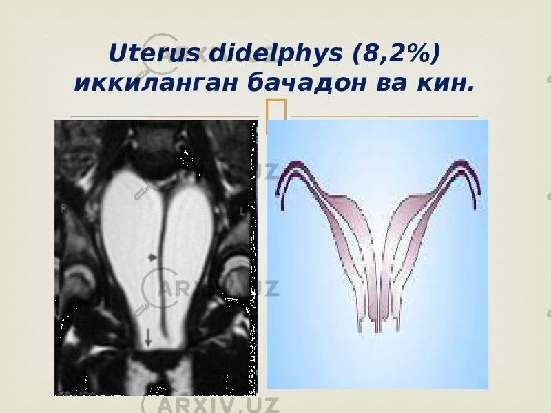 Uterus didelphys (8,2%) иккиланган бачадон ва кин. 