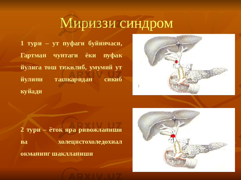 Мириззи синдром 1 тури – ут пуфаги буйинчаси, Гартман чунтаги ёки пуфак йулига тош тикилиб, умумий ут йулини ташкаридан сикиб куйади 2 тури – ёток яра ривожланиши ва холецистохоледохиал окманинг шаклланиши 