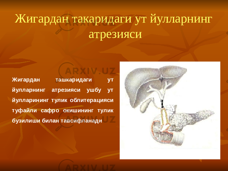 Жигардан такаридаги ут йулларнинг атрезияси Жигардан ташкаридаги ут йулларнинг атрезияси ушбу ут йулларининг тулик облитерацияси туфайли сафро окишининг тулик бузилиши билан тавсифланади 