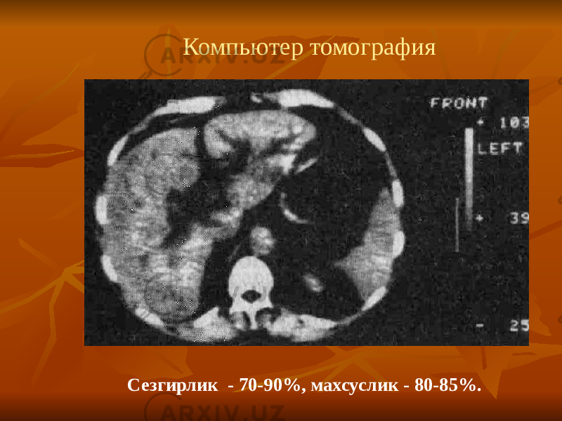 Компьютер томография Сезгирлик - 70-90%, махсуслик - 80-85%. 