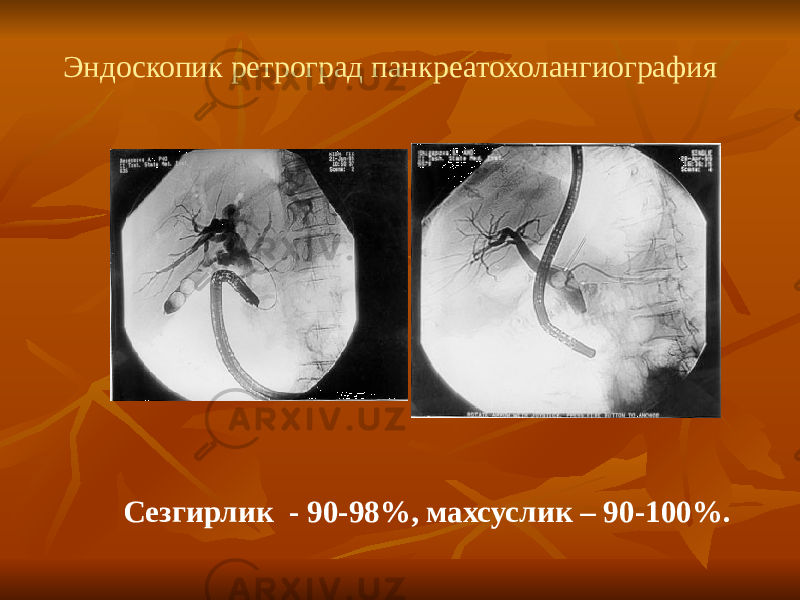 Эндоскопик ретроград панкреатохолангиография Сезгирлик - 90-98%, махсуслик – 90-100%. 