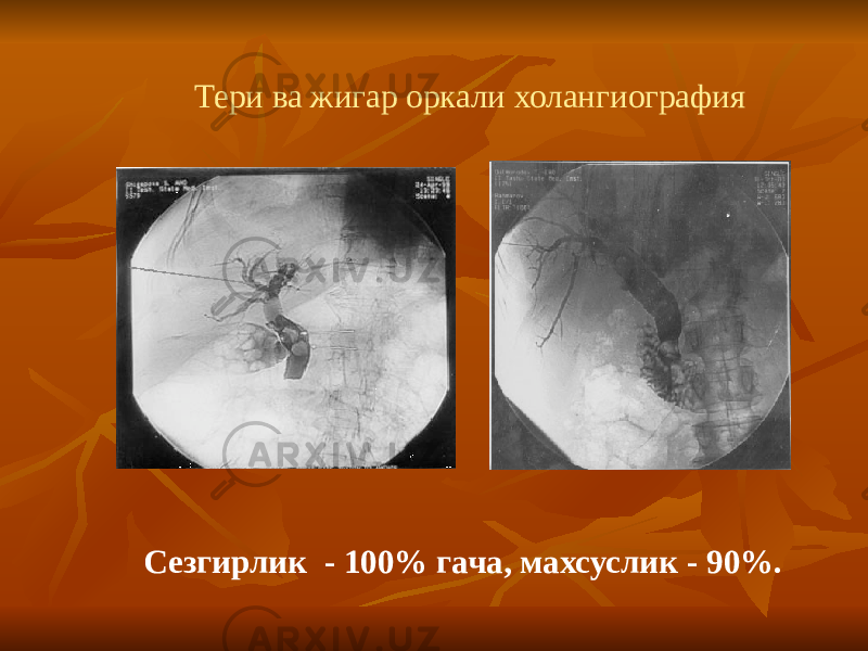 Тери ва жигар оркали холангиография Сезгирлик - 100% гача, махсуслик - 90%. 