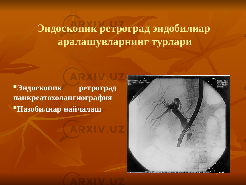  Эндоскопик ретроград панкреатохолангиография  Назобилиар найчалаш Эндоскопик ретроград эндобилиар аралашувларнинг турлари 
