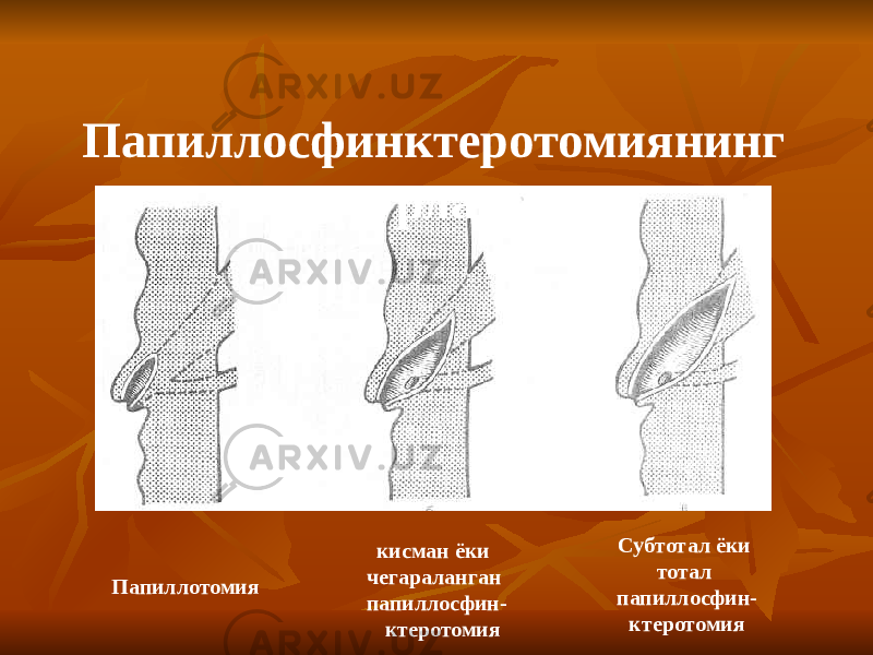 ПапиллотомияПапиллосфинктеротомиянинг турлари кисман ёки чегараланган папиллосфин- ктеротомия С убтотал ёки тотал папиллосфин- ктеротомия 