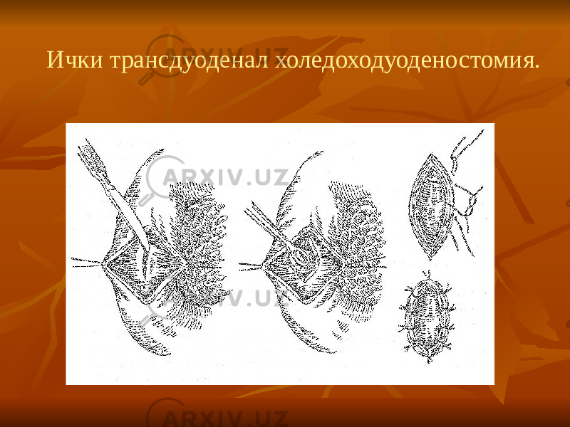  Ички трансдуоденал холедоходуоденостомия. 