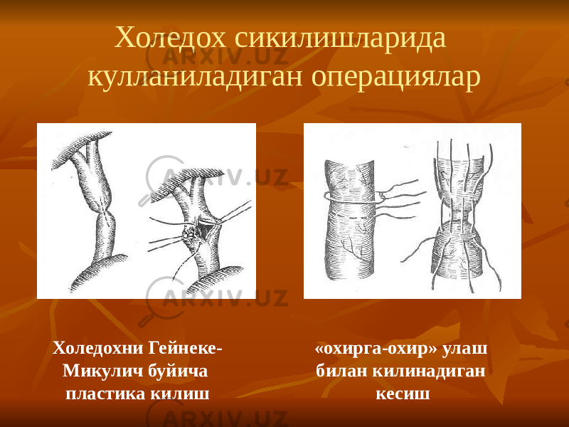 Холедох сикилишларида кулланиладиган операциялар Холедохни Гейнеке- Микулич буйича пластика килиш «охирга-охир» улаш билан килинадиган кесиш 