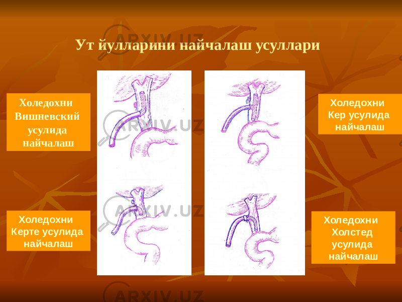 Ут йулларини найчалаш усуллари Холедохни Вишневский усулида найчалаш Холедохни Керте усулида найчалаш Холедохни Кер усулида найчалаш Холедохни Холстед усулида найчалаш 